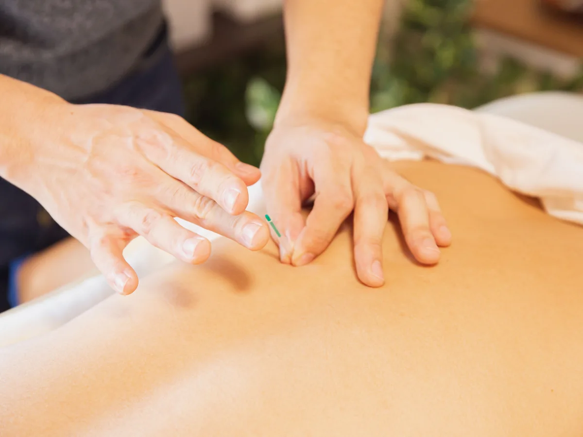 Real photo of acupuncture needles being placed in a patient’s upper back