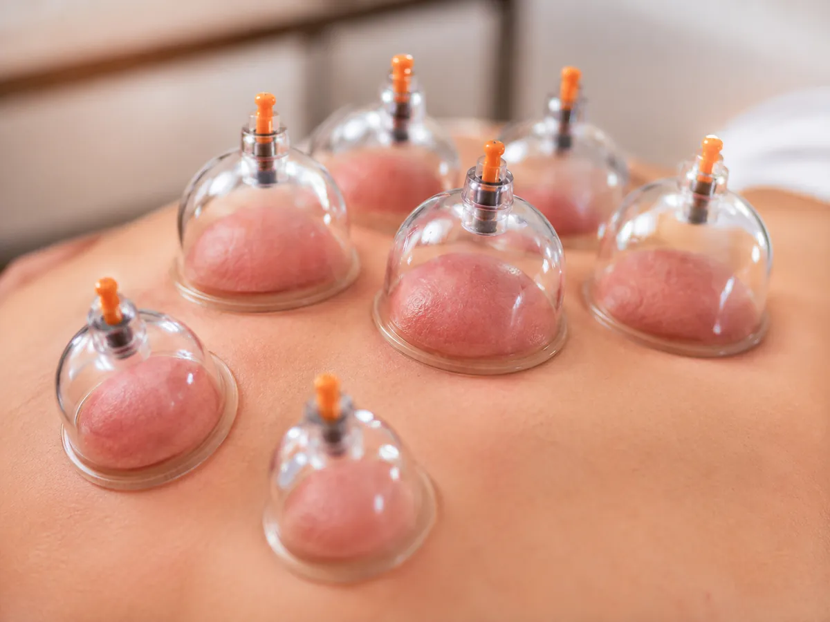 Cupping therapy being applied to the back