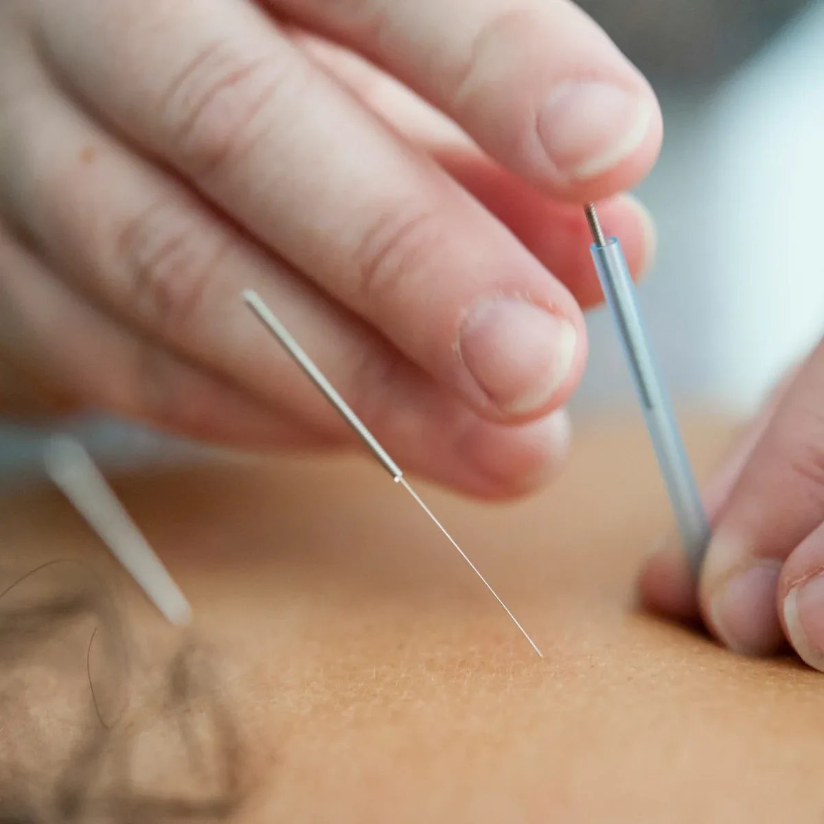 Close-up of acupuncture needles being placed during treatment