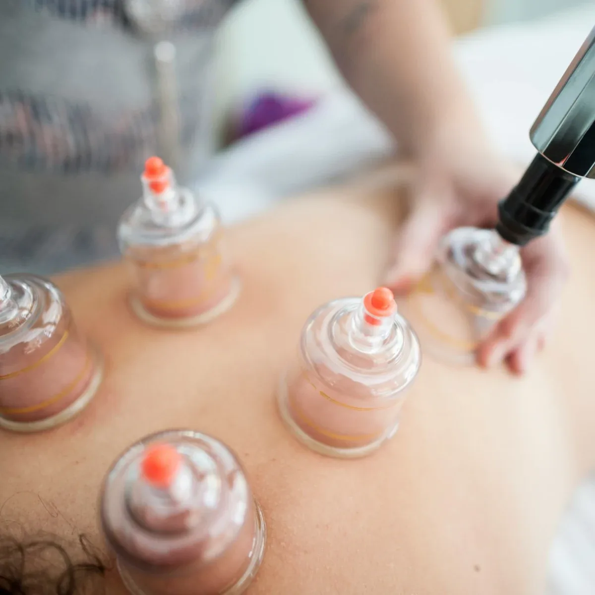 Cupping therapy being applied to the back